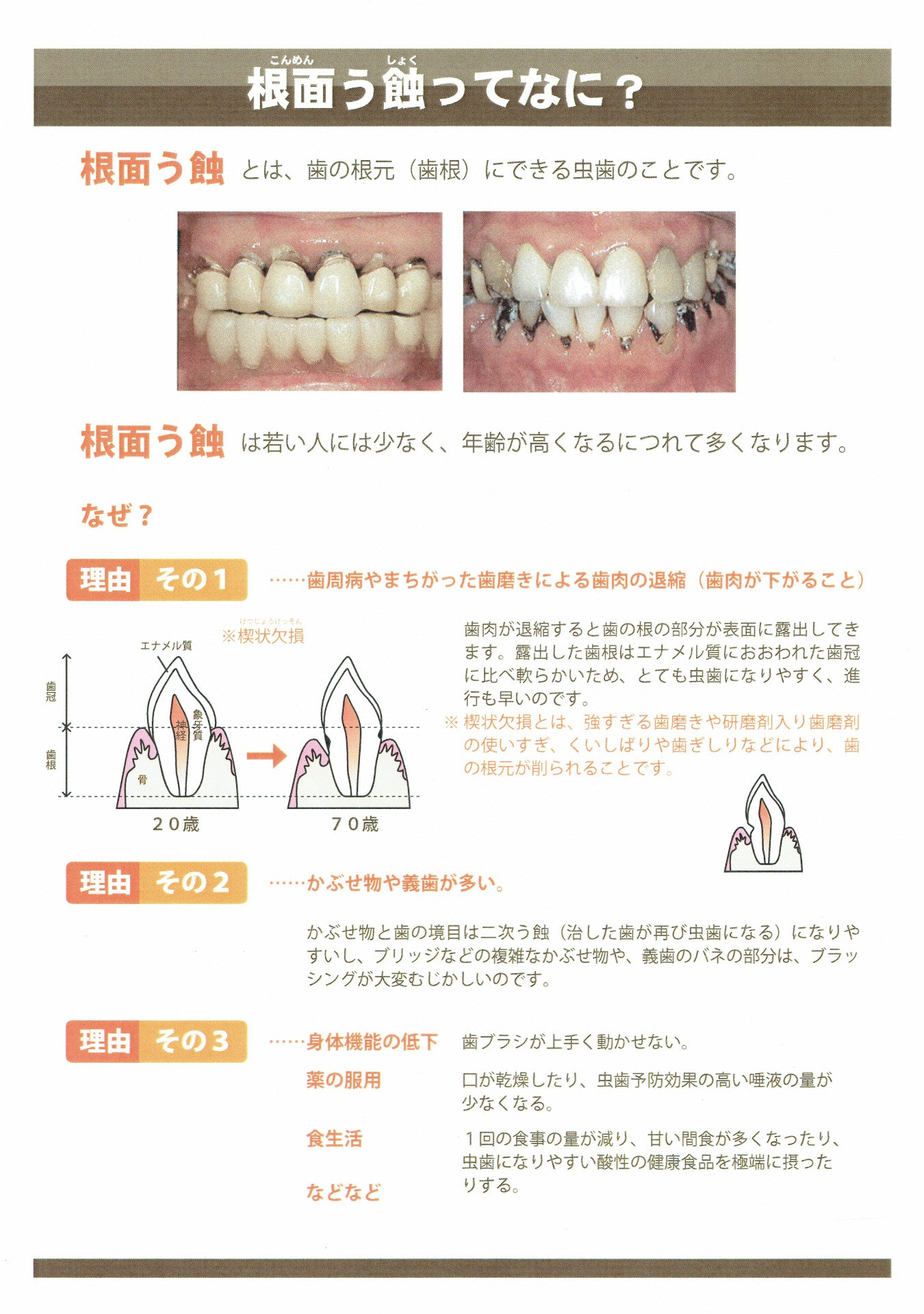 根面う蝕ってなに？