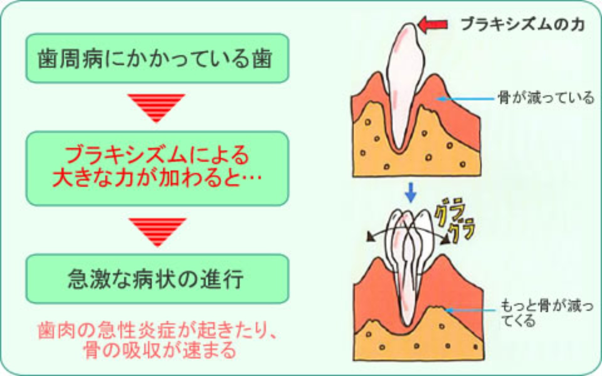 歯周病との相乗作用