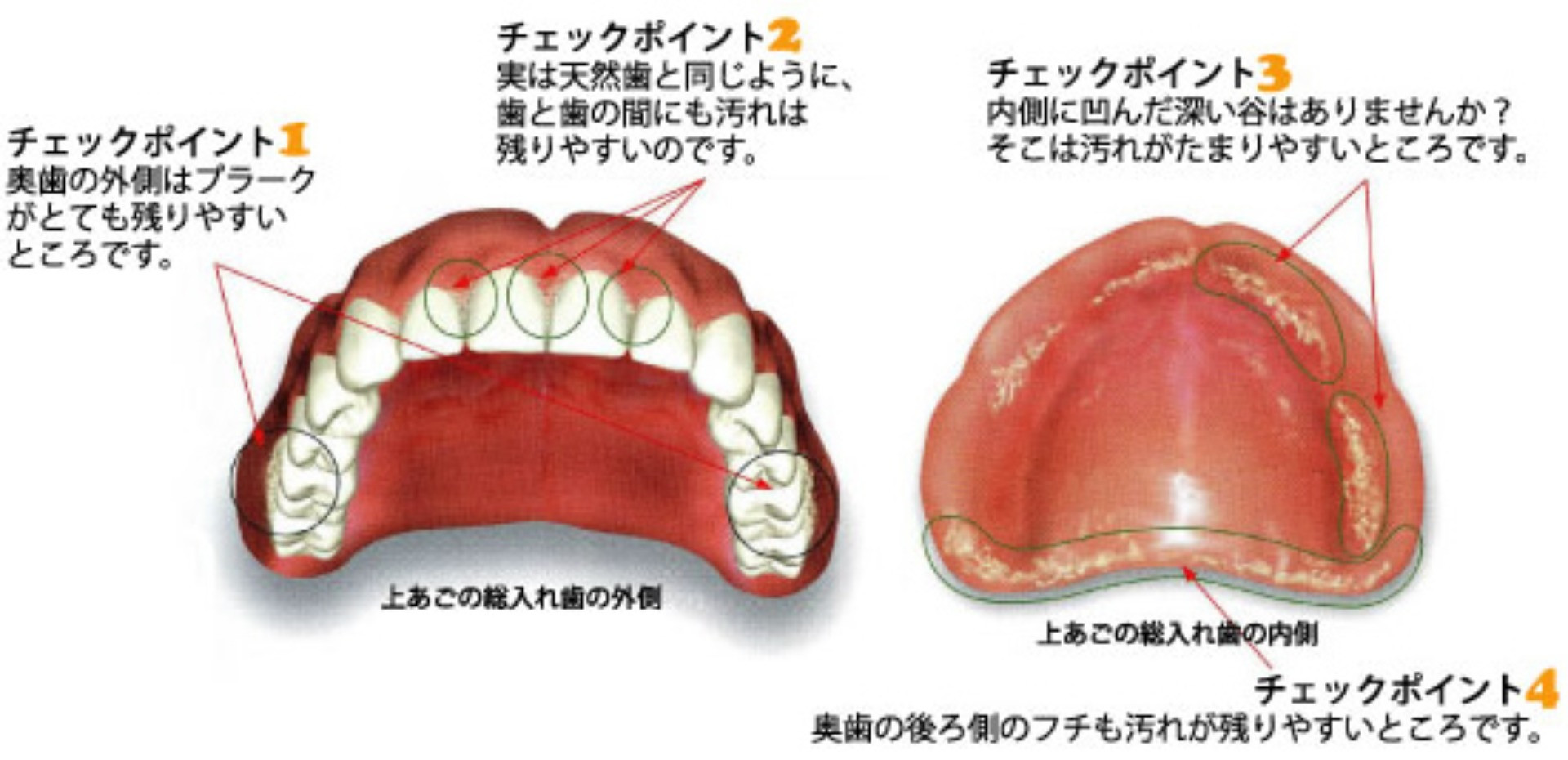 総入れ歯で汚れが付きやすいところ