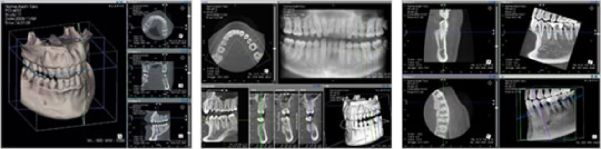 歯科用ＣＴ「AUGE（オージェ）SOLIO」