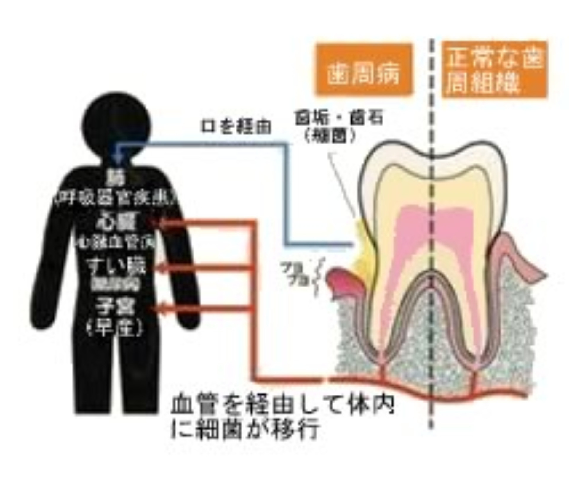 細菌は口や血管から体内に侵入する