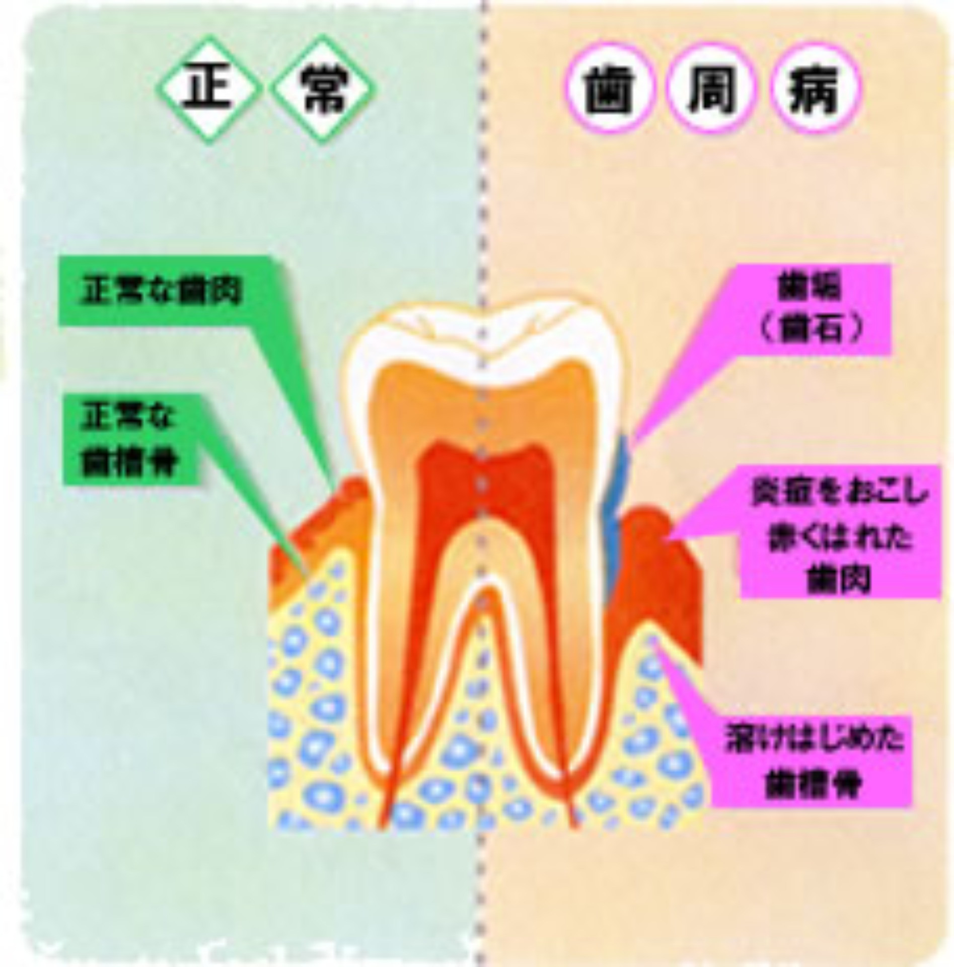 歯を失う最大の原因です