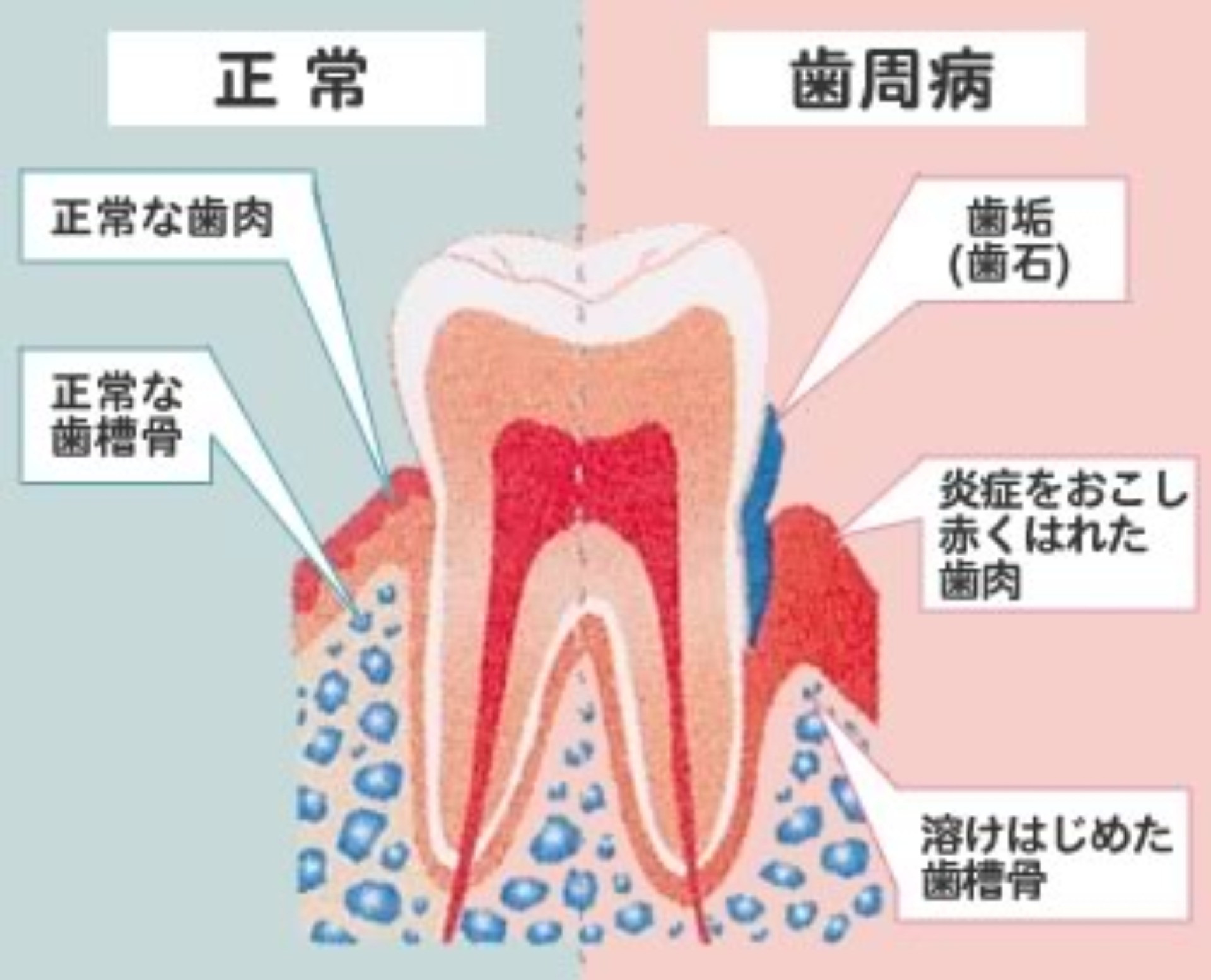 歯周病の原因