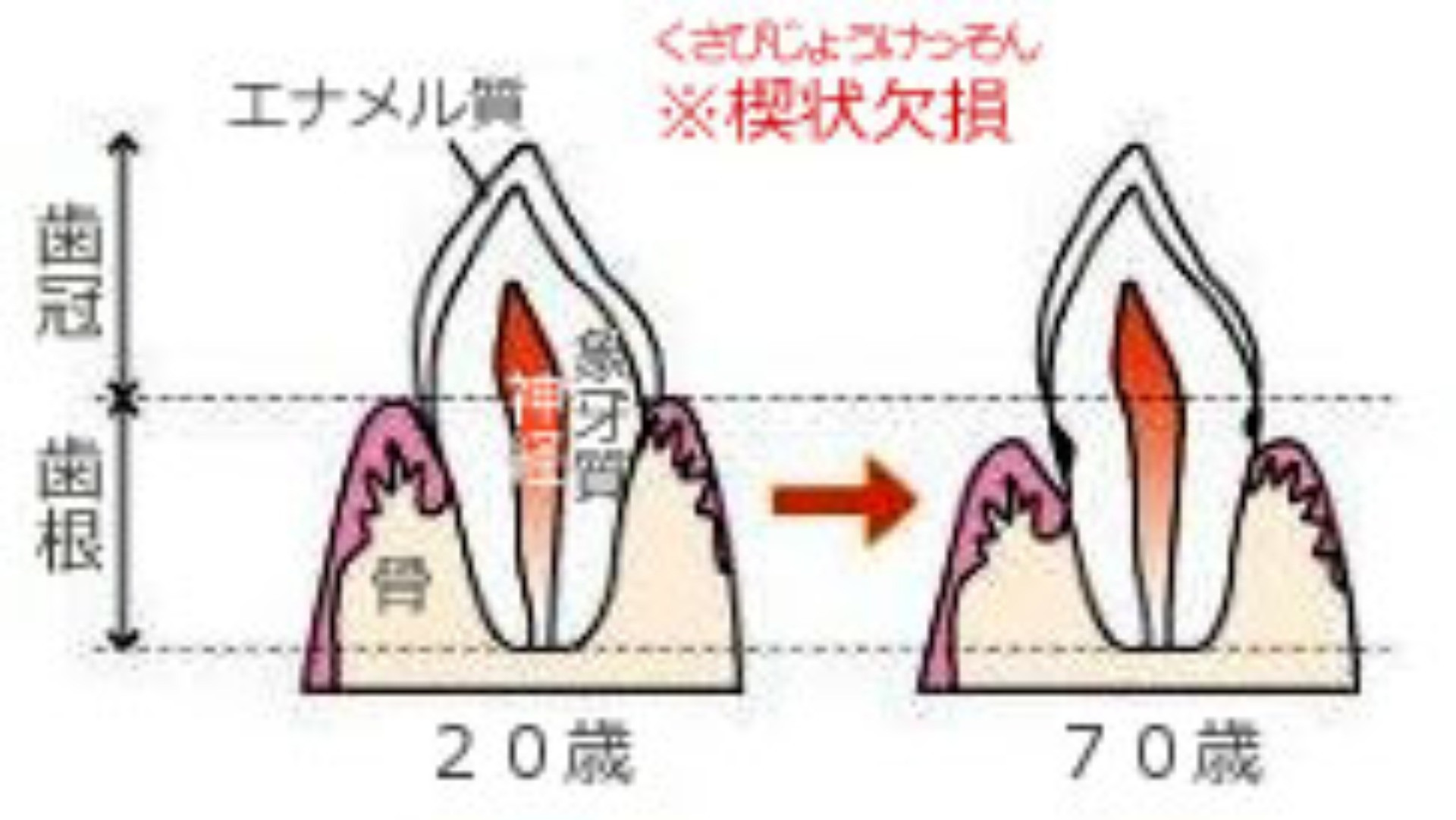 楔状欠損