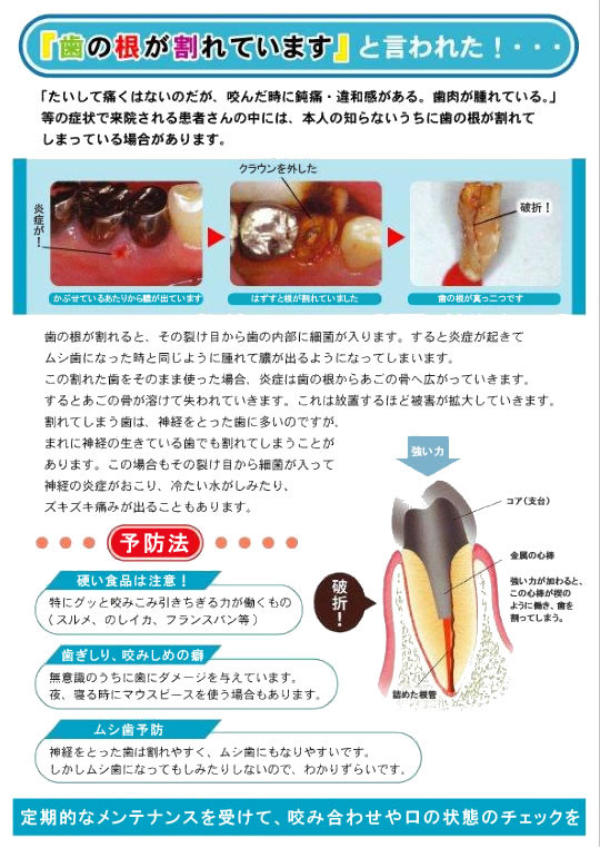 「歯の根が割れています」と言われた！