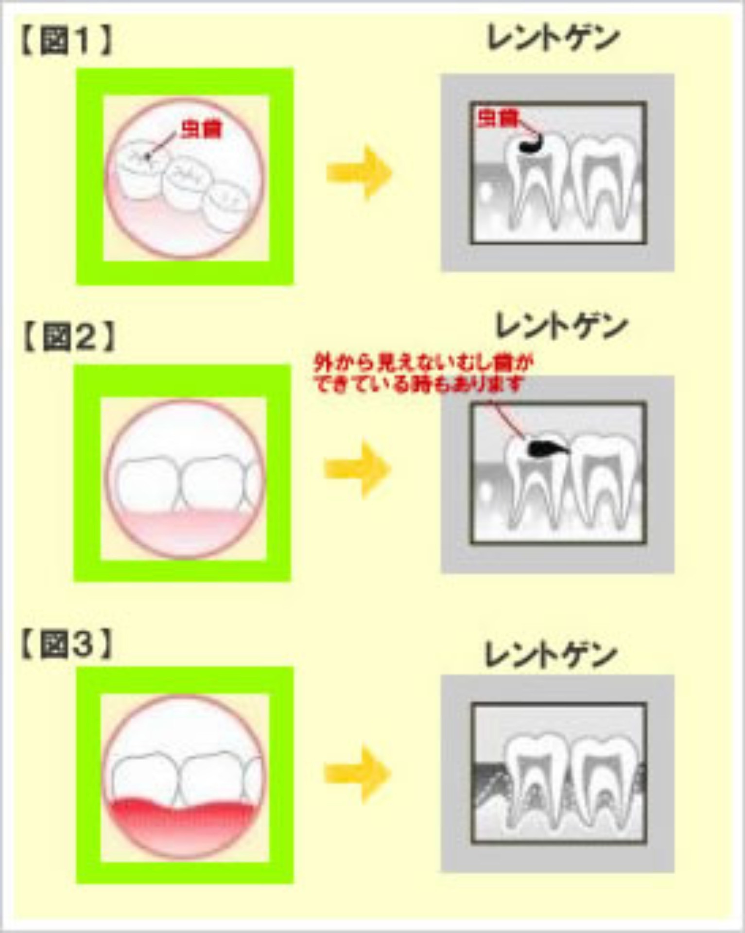 レントゲン