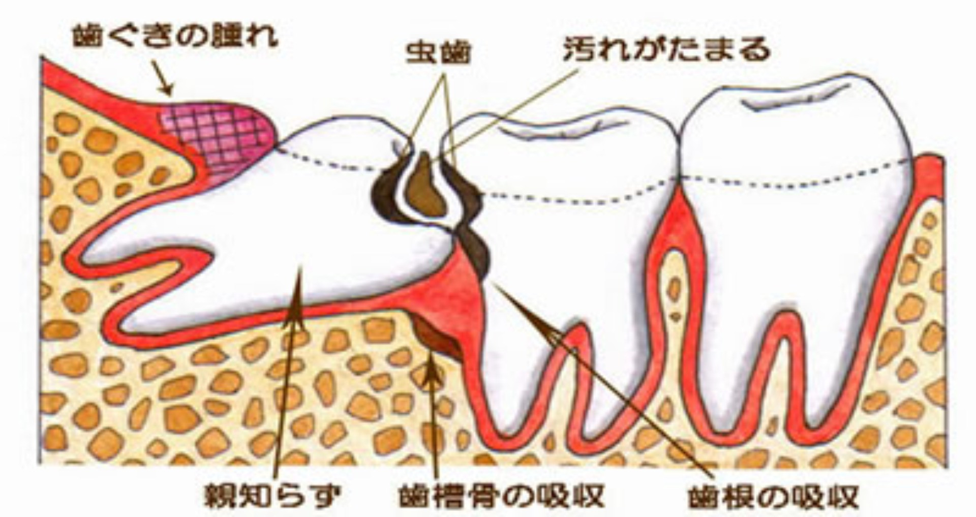 親知らずはすぐに虫歯になる