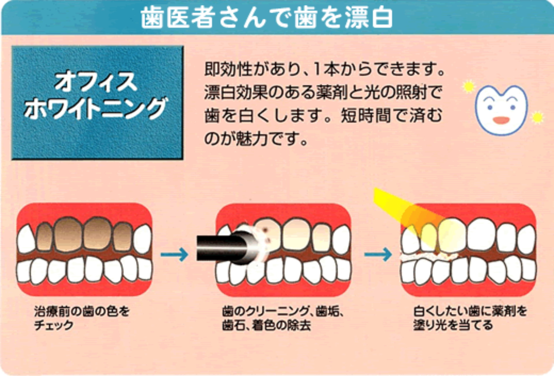 歯医者さんで歯を漂白