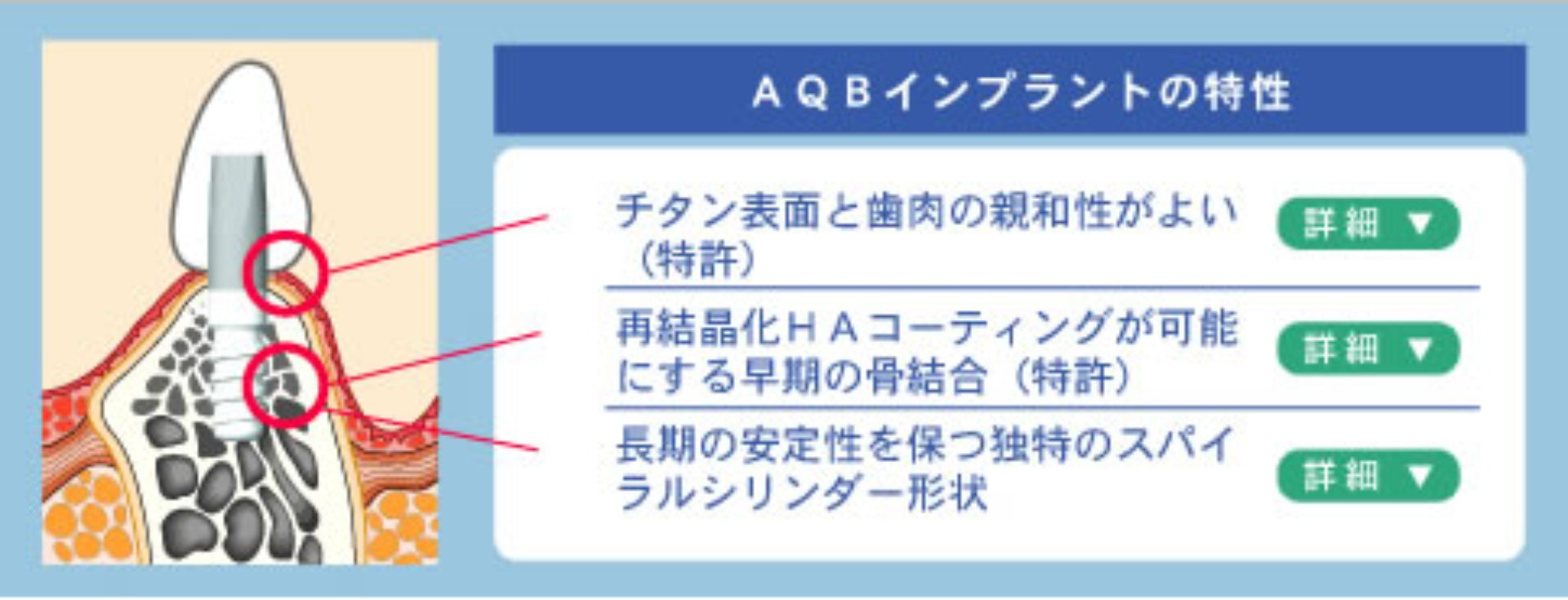 ＡＱＢインプラントの特性