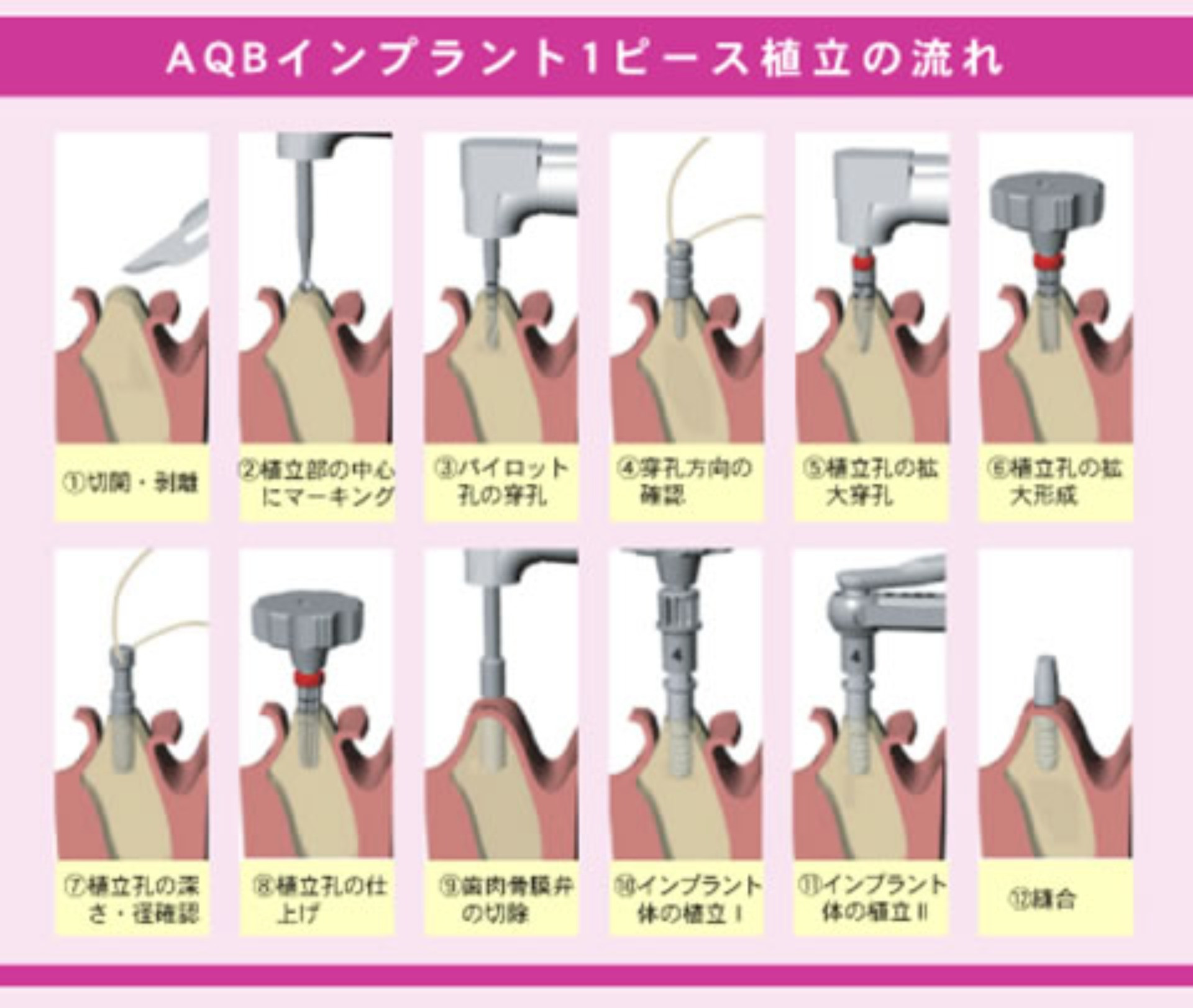 ＡＱＢインプラント1ピース植立の流れ