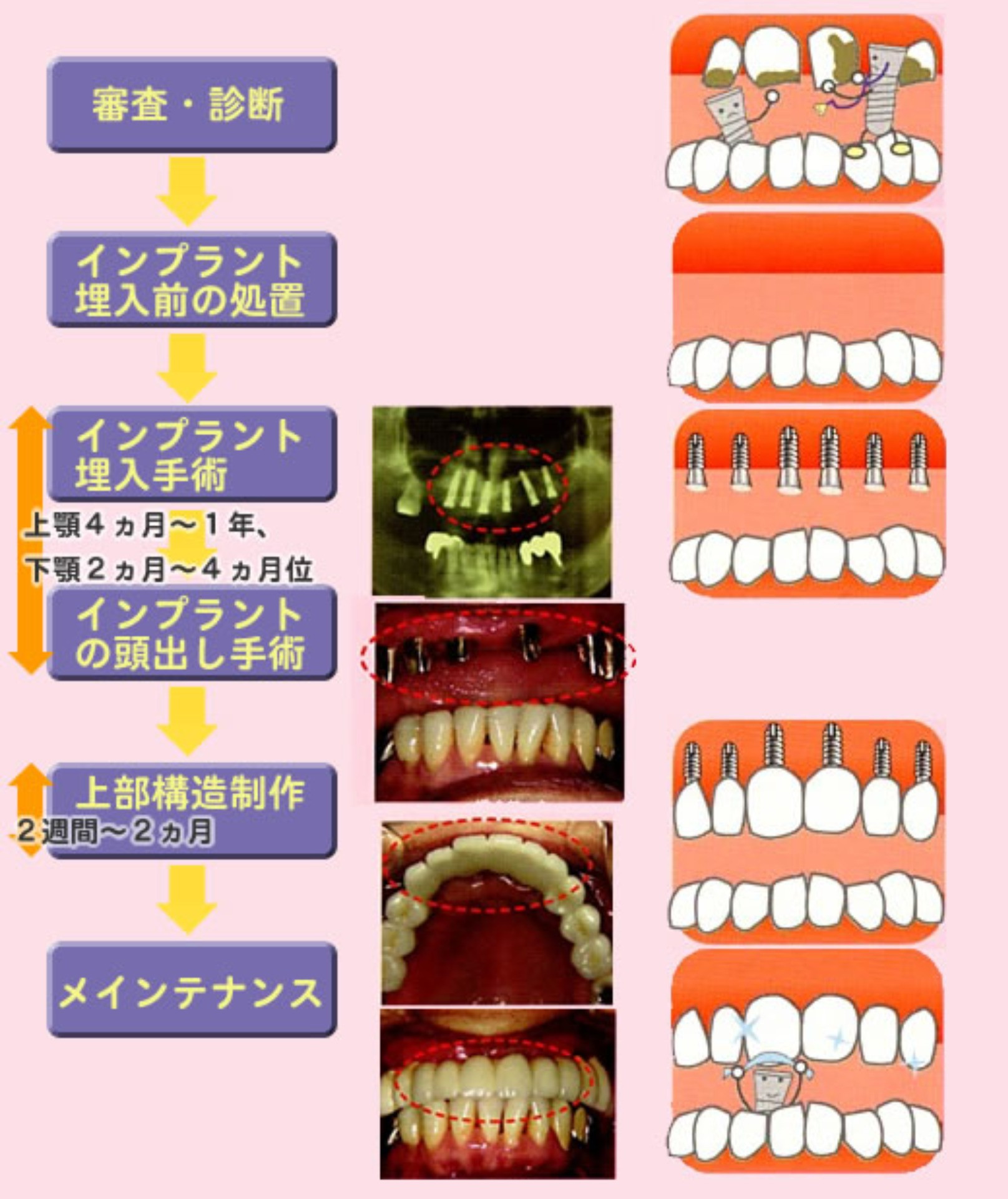 インプラント治療の流れ