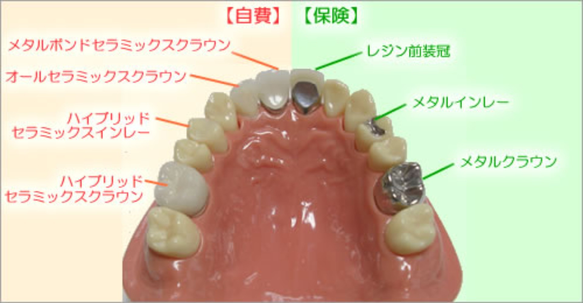 自費治療・保険治療