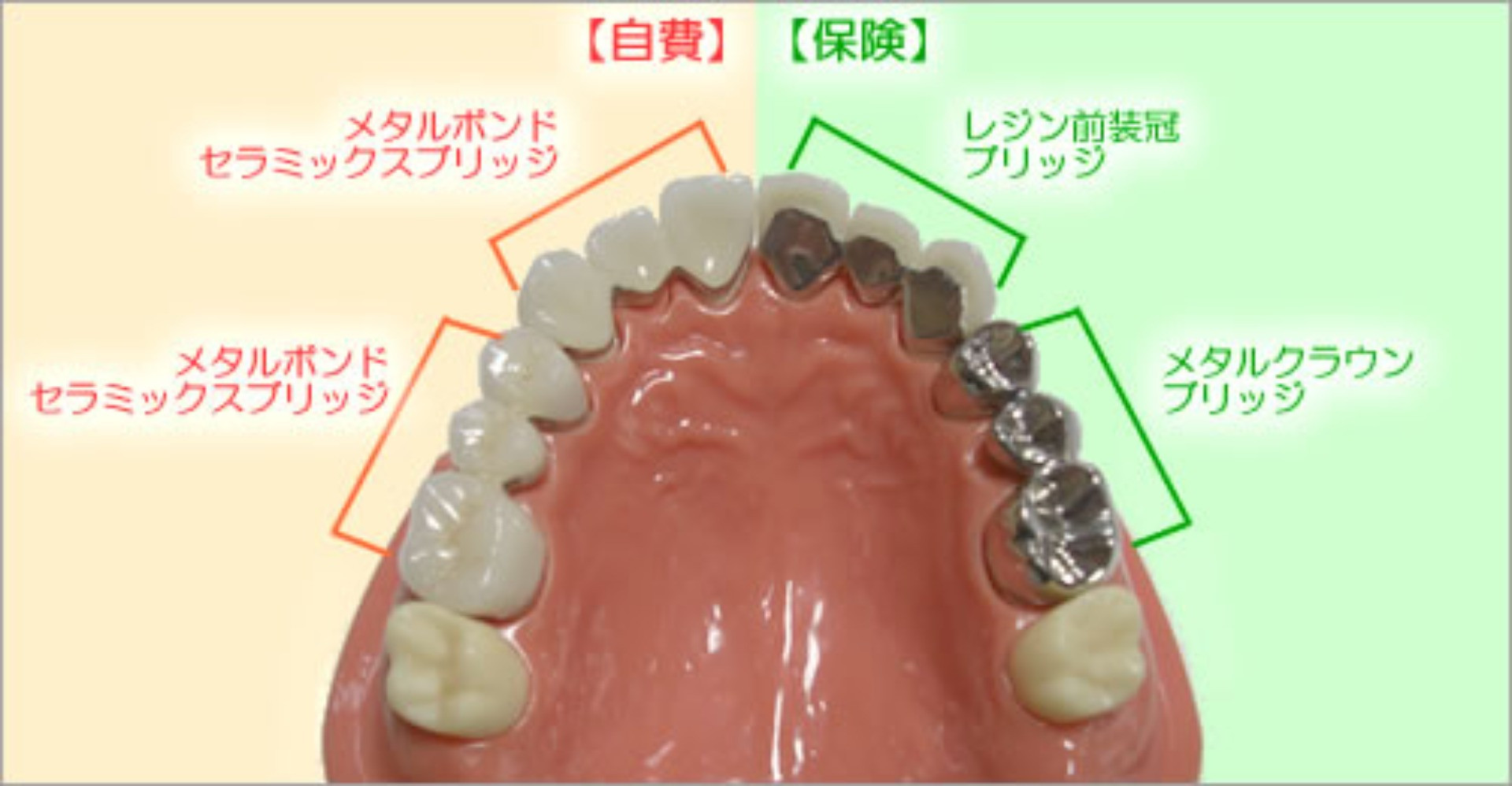 自費治療・保険治療