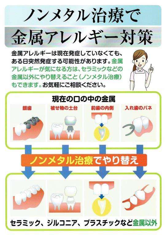 ノンメタル治療で金属アレルギー対策