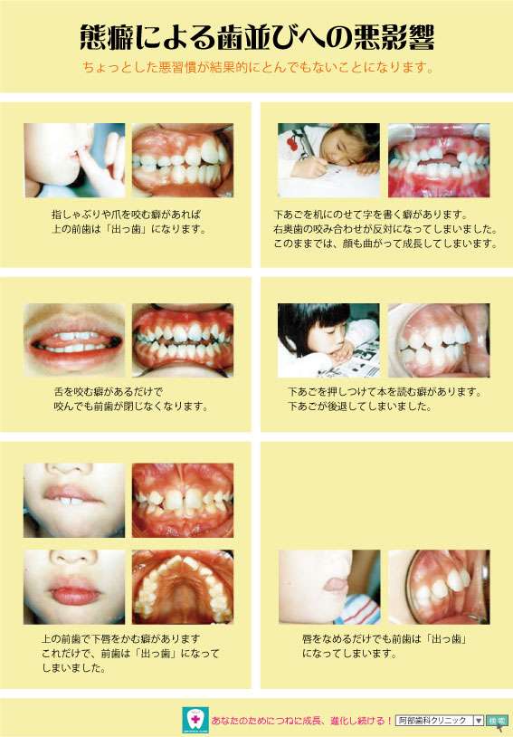 態癖による歯並びへの悪影響